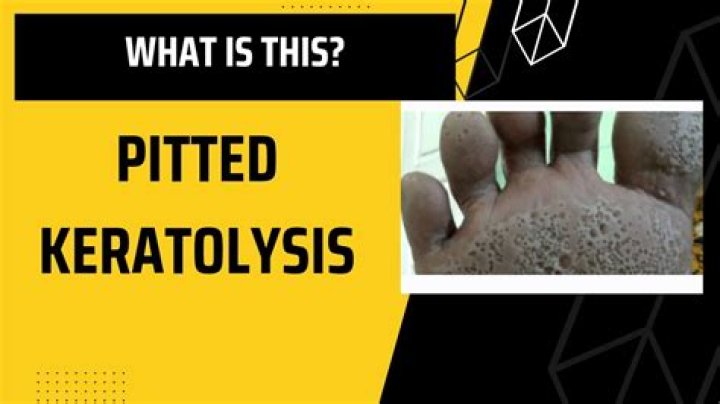How to get rid of pitted keratolysis